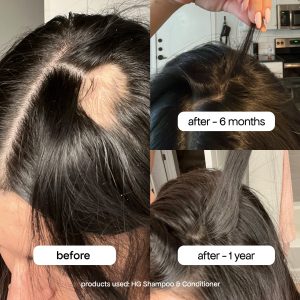 Alternative view of POSTPARTUM HAIR RECOVERY